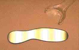 FIGURE 1 The small foot shaped double sided rhodium coated mirror is especially helpful for the lingual lateral view.