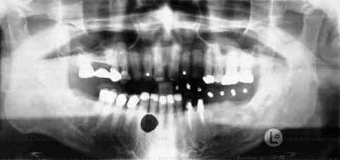 FIGURE 12 Film artifact on a panoramic film.