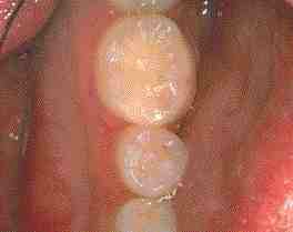 FIGURE 15 Final restoration. Notice the contour of the contact area, which replicates nature both functionally and esthetically.