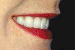 FIGURE 15 Post-operative lateral view. Compare to incisal edge position of teeth in Figure 4.