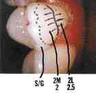 FIGURE 10 Gingival shade in the area marked 2L 2.5. Note the transition indicated.