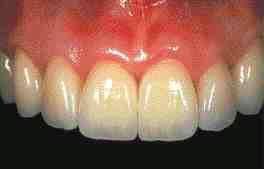 FIGURE 18 2 months postoperative view.