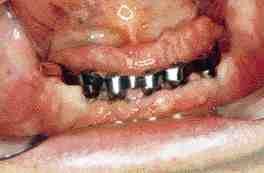 FIGURE 11 Clinical photograph of Case #3 showing the bar attached to the implants. This produces much greater support, and a much better prognosis. The prosthesis can now be made as an RP4 (implant born/implant retained).