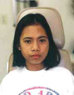 FIGURE 12 Post-operative dive view of patient after successful management of chronic diffuse sclerotic osteomyelitis of mandible.