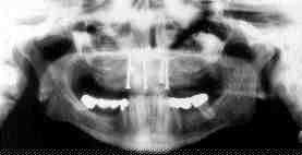 FIGURE 20 Ifiac crest onlay bone graft and sinus grafts post-operative radiograph.