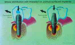 FIGURE 6 Illustration of transverse force components acting on threaded and porous-surfaced implants and the resulting peri-implant stress distribution. The 3-dimensional interlock of bone with the porous-surfaced implant results in a more uniform peri-implant stress distribution.