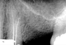 FIGURE 7 Radiographs confirms that the canals were successfully located.