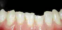 FIGURES 36 & 37 Provisional restorations which have enabled soft tissue adaptation, and the final veneers.FIGURES 38 & 39 Even on the most difficult teeth to prepare (lower anterior), all-ceramic restorations promote good tissue response with conservative preparations.