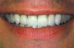 FIGURE 28 A frontal view of the completed restorations with the patient smiling. Note the incisal edges of the completed maxillary restorations follow the curvature of the lower lip, as the provisional restorations.