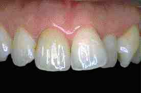 FIGURE 20 Immediate post-operative view of finished IPS Empress crown on #11.