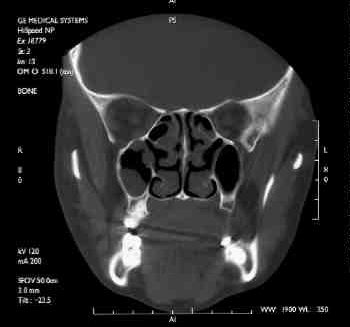 Figure 2C. CT scan showing pan-sinusitis with mucosal thickening in all sinus cavities.