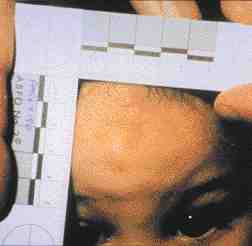 Adult bite mark. Victim also had cigarette burns on hands.