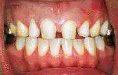 FIGURE 7A & B Preparation of the maxillary front 8 teeth. Note that the contacts were separated and the finish lines were on the lingual line angle.