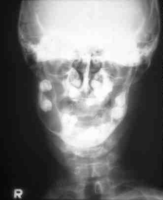 FIGURE 10 Odontogenic keratocyst from third molar.