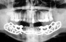 FIGURE 27 Final Panogram radiograph illustrating the cemented bridges on the circumferential subperiosteal implant. Note the distal extension of the bridges to the maxillary first molars.