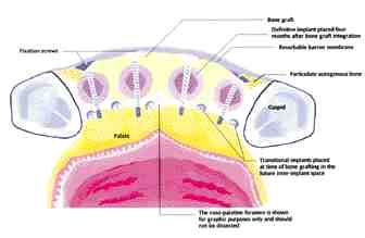 ILLUSTRATION 3 Fixation screws can be placed in the middle of the future location of the definitive implant. Temporary implants are then placed in a location that will be at least 2 mm away from the definitive implants four months down the road. If the opposite is done and the fixation screws are placed between the sites of the definitive implants or are placed at random then the TIs could end up too close to the definitive implants compromising blood supply and increasing the odds of complications. TIs will then have to be unscrewed and re-drilled into a new site causing further trauma and lengthening procedure time.