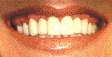 FIGURE 5B After completion of the crown lengthening extending from teeth 1.5 to 2.5, final restorations resulted in a desired symmetrical smile and less gingival exposure.