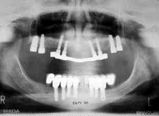 FIGURE 15 Interim panoramic radiograph showing the additional 4 maxillary implants in preparation for converting the maxillary overdenture to a fixed maxillary bridge case.