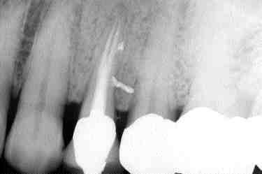 FIGURE 14B A 10-year post-treatment radiograph reveals excellent healing and confirms the importance of treating the root canal system.