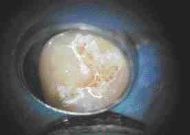 FIGURE 29 16x magnification of cavity preparation viewed with #1 mirror.