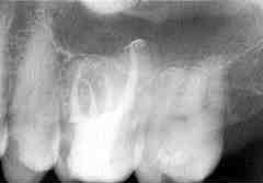 FIGURE 15 The mesiopalatal canal is merging with the mesiobuccal canal at 90 degrees. The introduction of rotary nickel titanium files in the part in common between the two canals could be very dangerous.