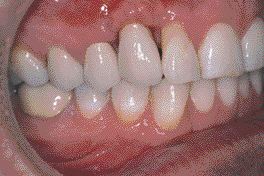 FIGURE 17--The final crown placed on the milled abutment head intraorally. This image was taken at the insertion visit.