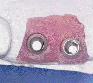 FIGURE 11--Occlusal close-up of the soft tissue portion on the final cast.