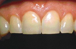 FIGURE 16--Post-treatment close-up of the maxillary incisors, including the completed all-ceramic crown.