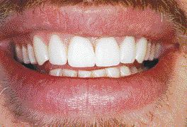 FIGURE 4--Definitive restorations with proper function and aesthetics.