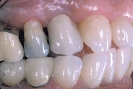 FIGURE 5C--Picture of upper and lower right quadrants; 1.6, 1.5, 1.4, 1.3, 1.2, PFM implant-supported crown at site 1.4 restored by Dr. Susan Murray, (note the formation of a full papilla in the 1.3/1.4 embrasure space but not in the 1.4/1.5 embrasure space) .