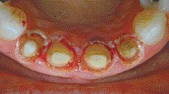 FIGURE 6A & B--Circumferential gingivectomies and soft tissue curettage accomplished with electrosurgery to obtain the desired contours and eradicate the infection.
