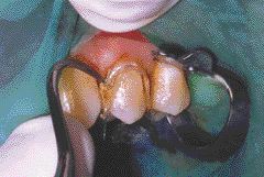 FIGURE 21--Belvedere matrix is easily removed when the restoration is completed.