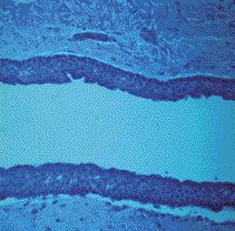 FIGURE 10--Photomicrograph showing left mandibular cyst wall composed of fibrous tissue and lined by keratinized epithelium with a polarized basal cell layer (Haematoxylin and Eosin x 40).