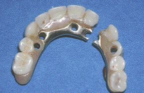 FIGURE 10--Framework Fracture of Fixed Implant Prosthesis.