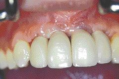 FIGURE 39--This is the final result at the time of insertion. The 5 mm distance between the bone level and the first interproximal point of contact will allow the papillae to be maintained and the results will be more esthetically pleasing.