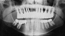 FIGURE 11--A panoramic radiograph demonstrating the final restoration in place.