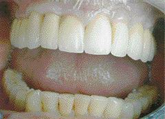 FIGURE 15--The final restoration.