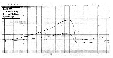 FIGURE 4--Typical sD Tracing from a tooth lased at 0.75 Watts using a 245 micron fiber optic for apical and coronal.