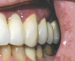 CASE 4: FIGURE 32--Post-op PA.