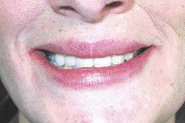 FIGURE 30--Final full frontal smile.
