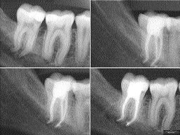 FIGURE 14--This clinical example of a complex and tortuous root canal system microstructurally replicated with the Epiphany Obturating System demonstrates the efficacy potential of both the THC technique and this new iteration in the armamentarium of endodontic space closure. (Courtesy of William Watson, DDS.)