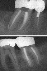 FIGURE 18--Mandibular molar with lateral canals filled in apical third of distal root.