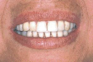 FIGURE 10--Post-treatment smile.