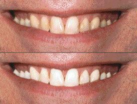 FIGURE 6--Simulated whitening using imaging software.