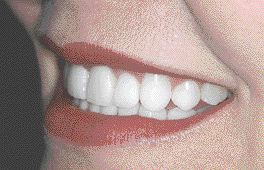 FIGURE 21--Left side smile after veneers.