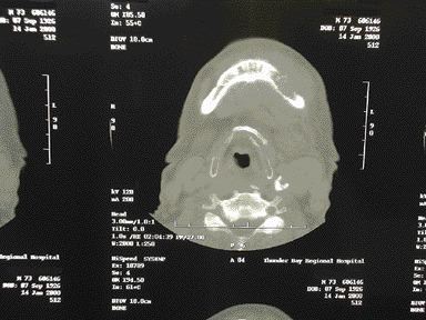 FIGURE 2--CT scan of the inferior aspect of the mandible. Axial view shows a lytic defect approximately 2 cm. in diameter with a fracure in the lingual cortex.