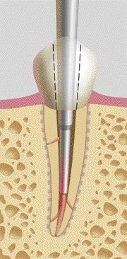 FIGURES 22-28--BACK FILLING. Applicator tips for the Obtura II system are available in sizes #20, #23, and #25 gauges. Additional root canal sealer may be placed in the coronal aspect of the root canal with a hand file prior to back filling. 4-6 mm aliquots of RealSeal are injected into the canal space then immediately condensed with the pre-fitted Schilder or Buchanan hand pluggers in sequence using the sequentially larger pluggers as the coronal aspect of the canal is approached. As thermosoftened RealSeal is deposited in the canal, backpressure is produced and the applicator is forcibly extruded from the canal space. It is essential that the operator continue injecting as the applicator tip is retrieved from the canal in order to avoid inadvertent removal of the newly deposited RealSeal mass prior to condensation.