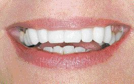 FIGURE 58--The end result is esthetically very pleasing. Because of the low lip line, the FP3 prosthesis has an excellent patient acceptance. The patient was very pleased with the fixed end result. The case has been finished for five years now, and there have been no complications.