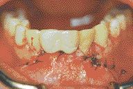 FIGURE 35--The temporary bridge is replaced and the patient can continue with his referral for the abutment placement four mounts later and the steps for the final restorations.