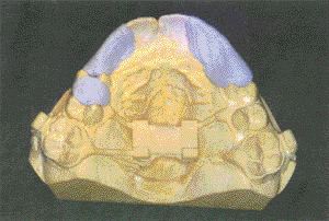 FIGURE 8C--Dental stone cast with block-out materials in place, used for patient in figures 8a and 8b.